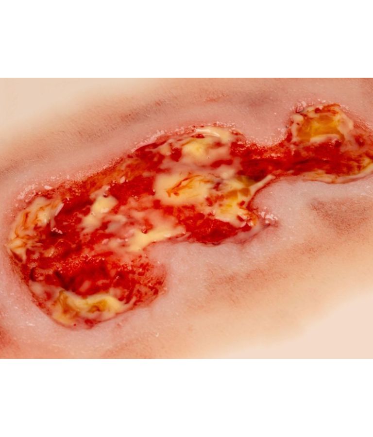 Plaie simulée d'ulcère veineux de jambe, petit, en phase d'exsudation vue de près