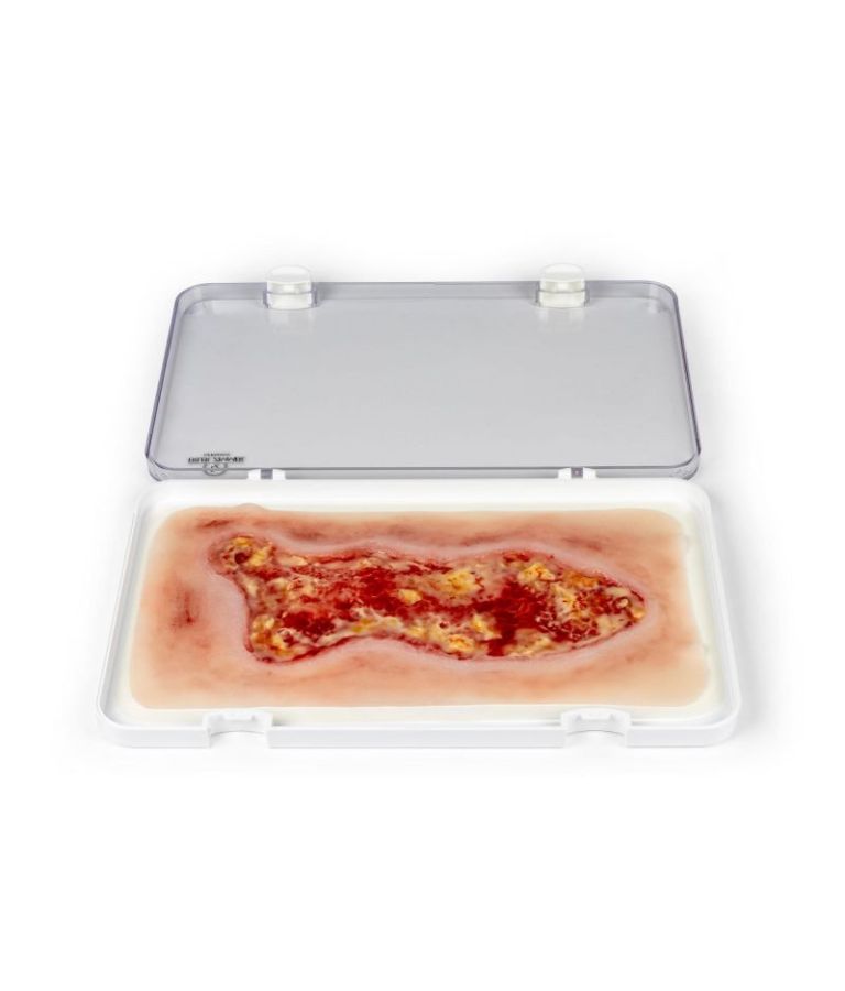 Plaie simulée : ulcère veineux de jambe, étendu, en phase d’exsudation