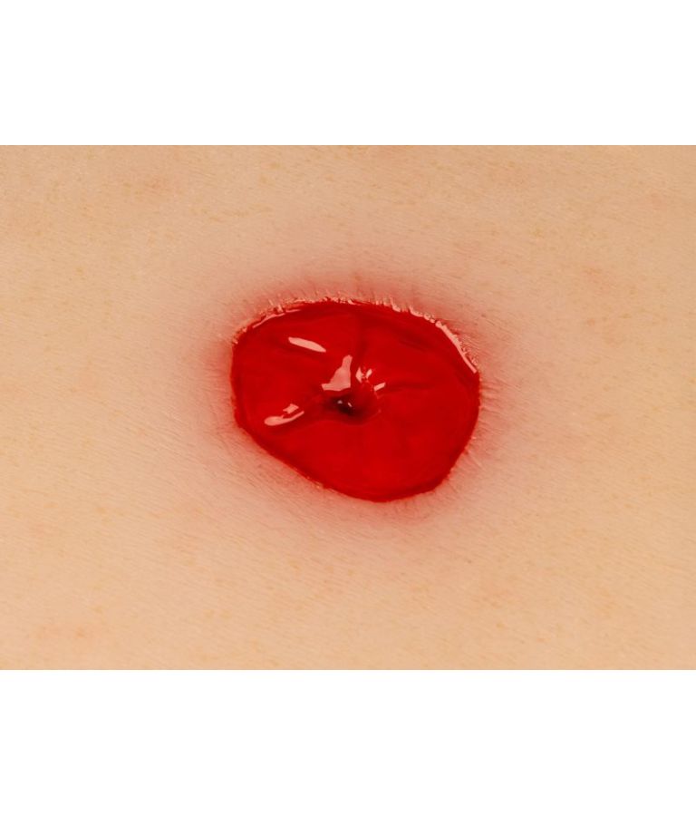 Moulage de plaie colostomie en dessous du niveau de la peau, avec base vue de près