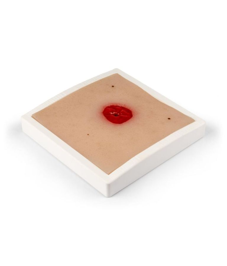 Moulage de plaie colostomie en dessous du niveau de la peau, avec base