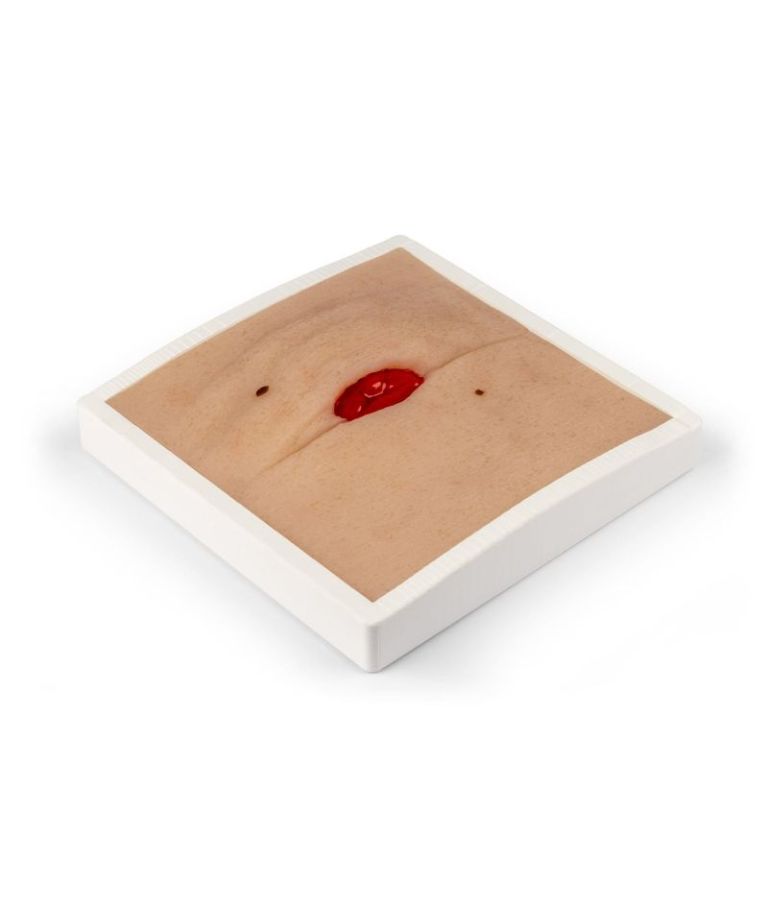 Moulage de plaie colostomie en plie abdominal, avec base
