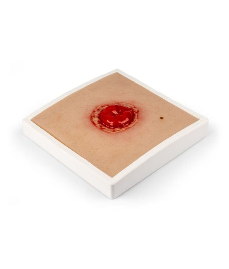 Moulage de plaie colostomie, enflammé, avec base