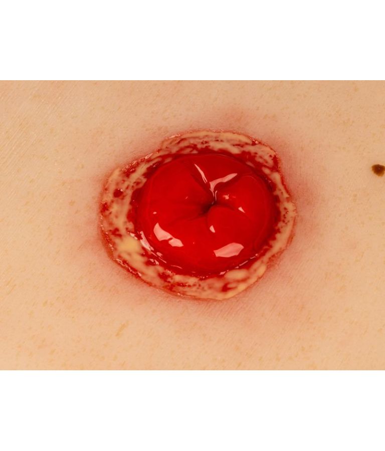 Moulage de plaie colostomie, enflammé, avec base vue de près