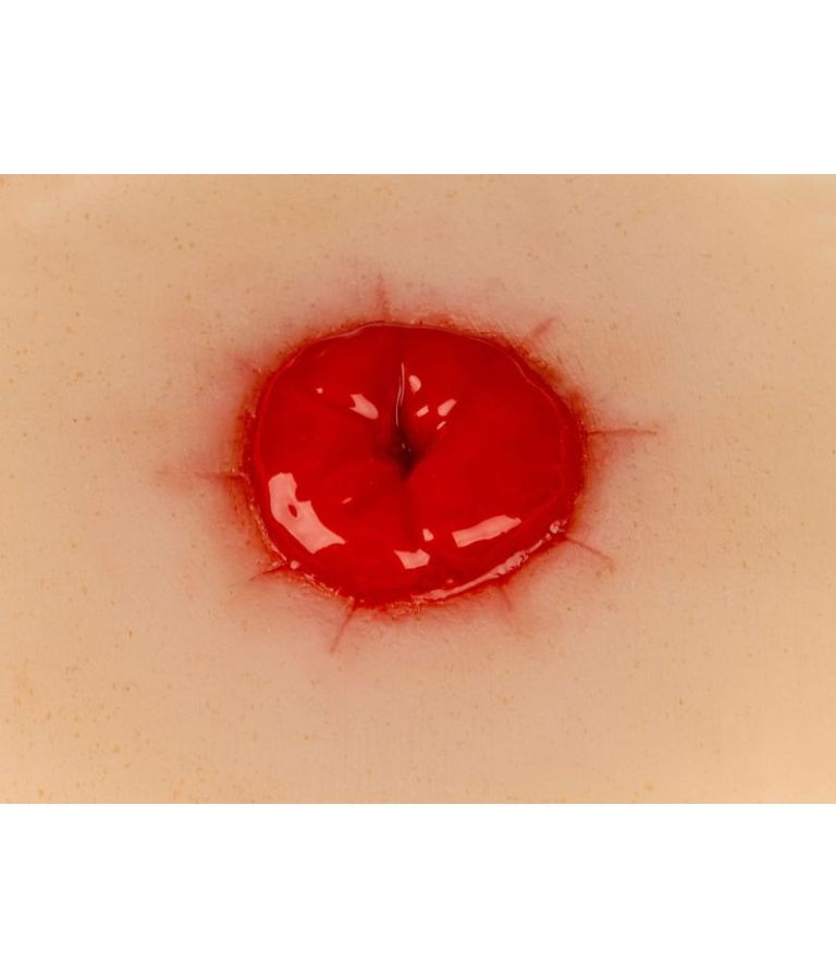 Moulage de plaie colostomie, avec base vue de près