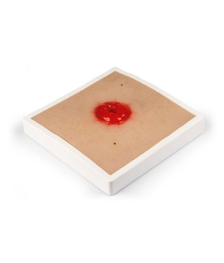 Moulage de plaie colostomie, avec base