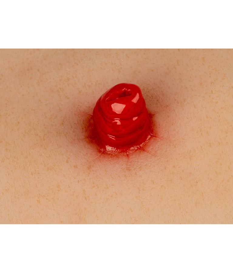 Moulage de plaie iléostomie, avec base vue de près