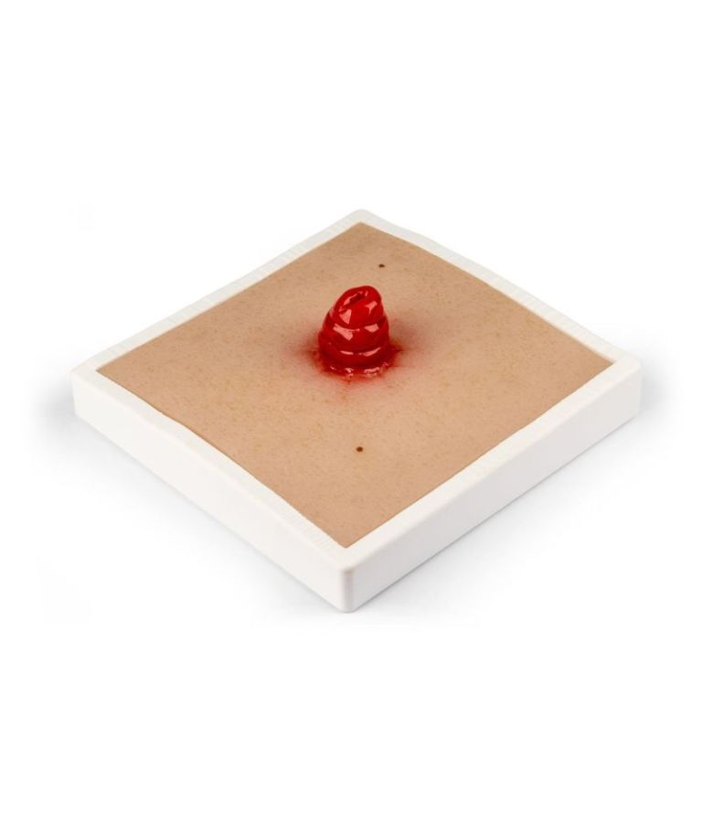 Moulage de plaie iléostomie, avec base